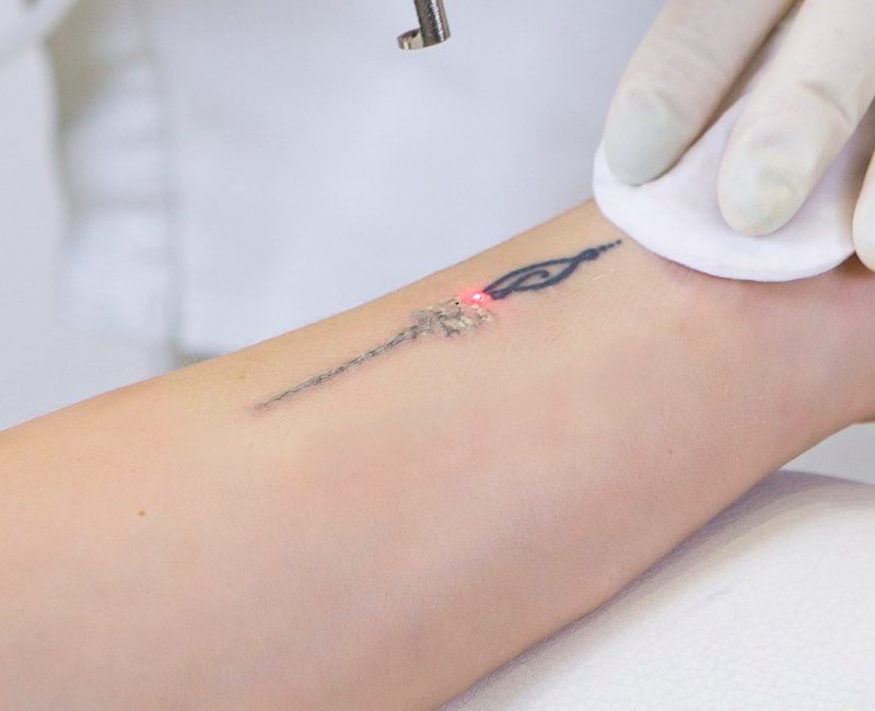 quitar tatuajes precio económico
